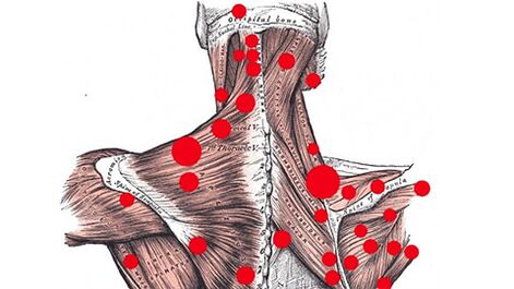 Puntos desencadeantes nos músculos que causan dores nas costas miofasciais