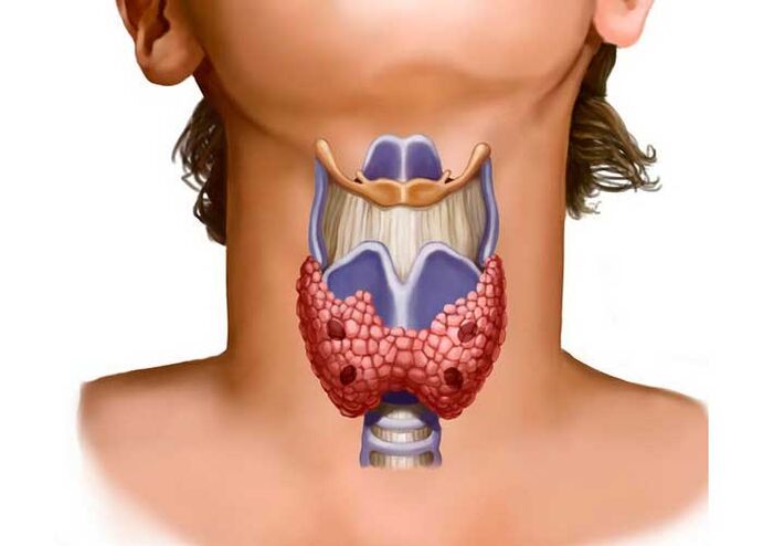 Problemas de tiroides como causa da dor no pescozo