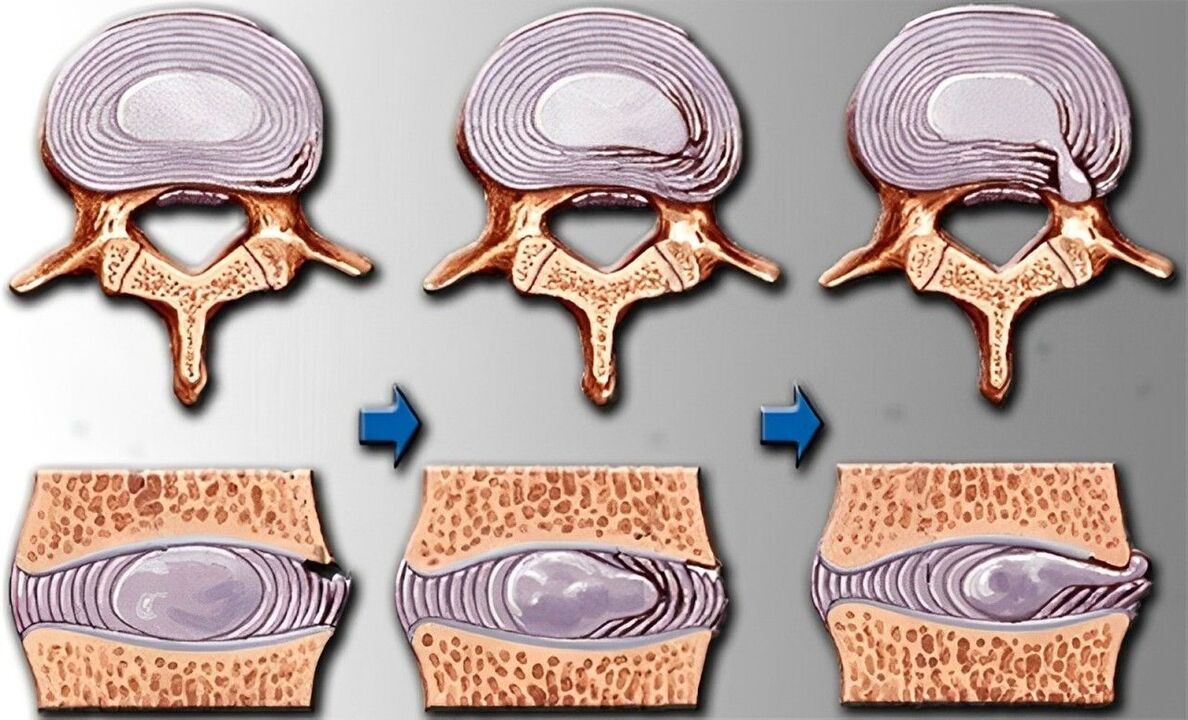 Etapas da osteocondrose