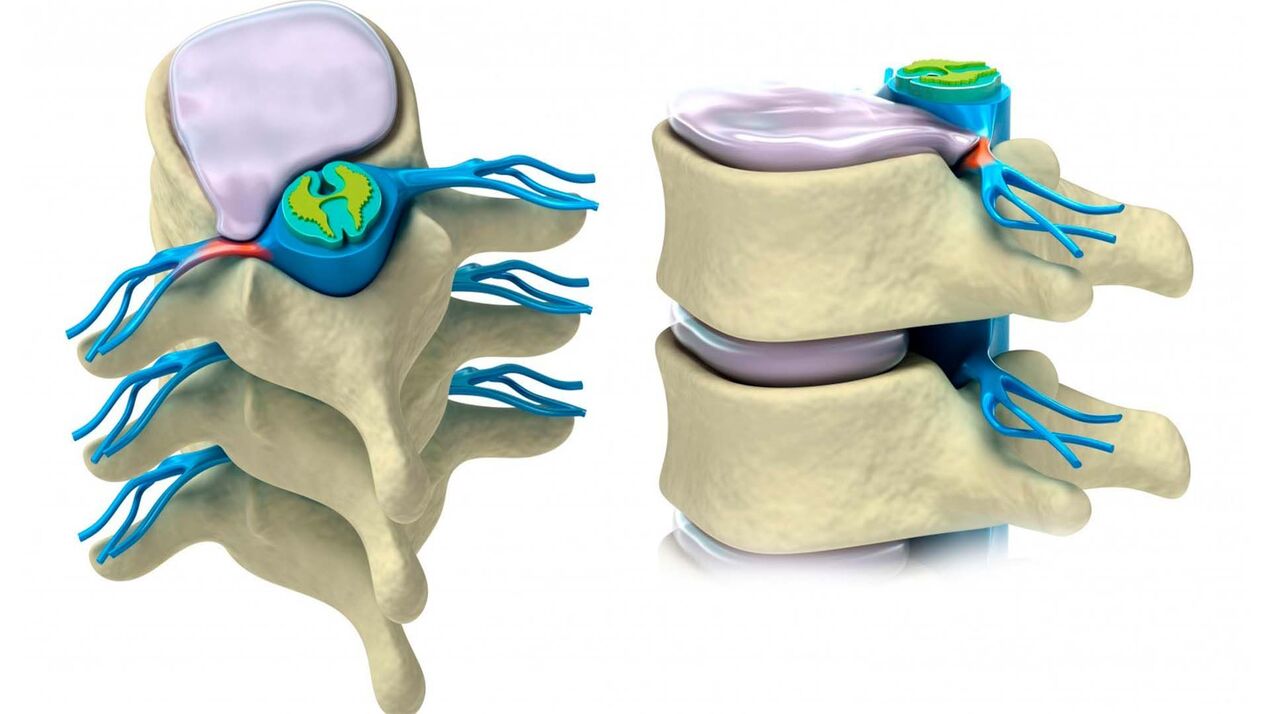 disco intervertebral danado