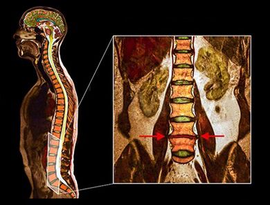 Disco duro dexenerativo na columna vertebral
