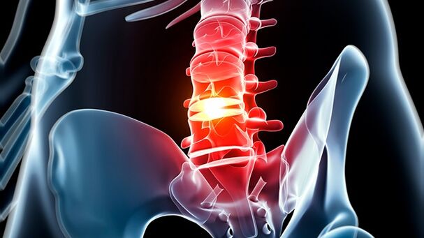 Osteocondrose da columna vertebral lumbar
