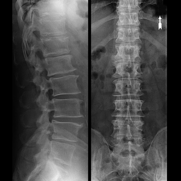 Osteocondrose da rexión vertebral na radiografía