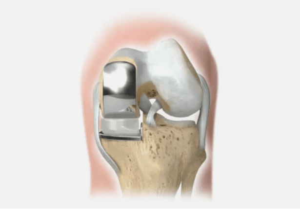 parte da articulación está danada