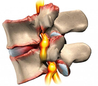 Osteocondrose da columna vertebral